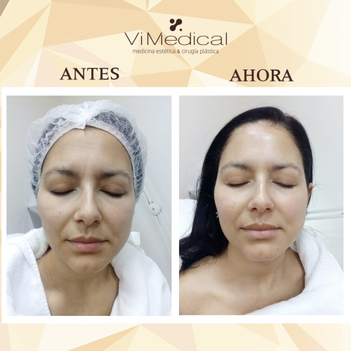 Tratamiento Regenerador Facial